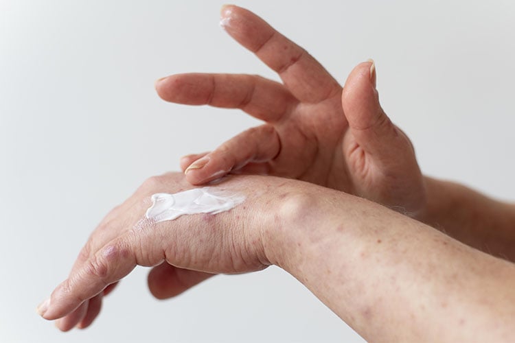 mulher passando pomada na mão com alergia representando os tipos de dermatite