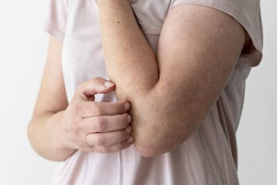 Tipos de dermatite: conheça as causas e os principais sintomas